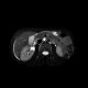 Cyst of pancreas, pancreatic cyst: MRI - Magnetic Resonance Imaging